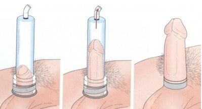 Agrandamiento del pene con bomba