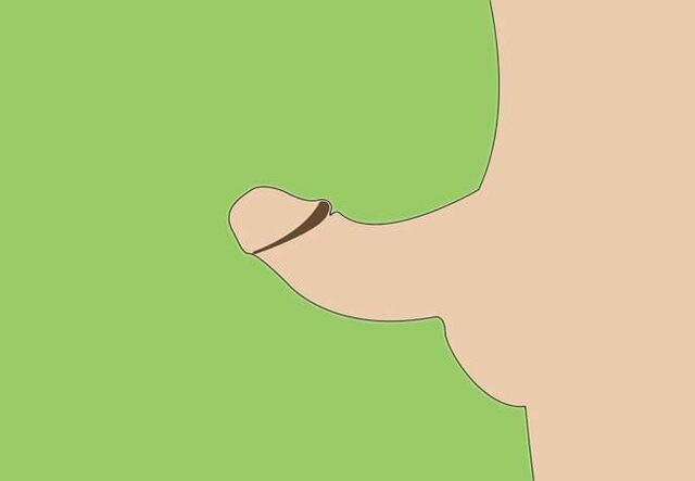 Curvatura del pene como indicación de agrandamiento quirúrgico.